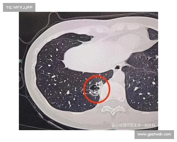 医院负次责!m肺结节患者穿刺术后死亡,一级甲等医疗事故引发关注 医院负次责!m肺结节患者穿刺术后死亡,一级甲等医疗事故引发关注